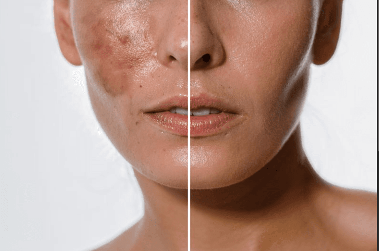 Peeling Behandeling behandeling bij Noor Clinics